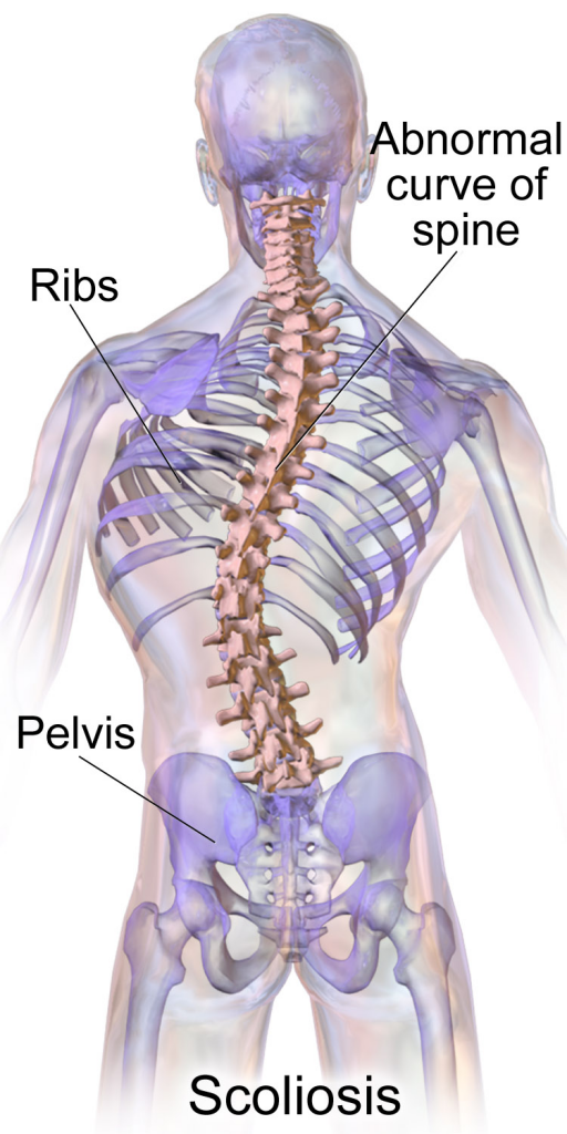 Scoliosis Causes and Best Treatment Pain & Posture Wellness Centre